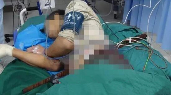 厦门工人作业时突然失足坠落 钢筋从其身体穿过-医院救援