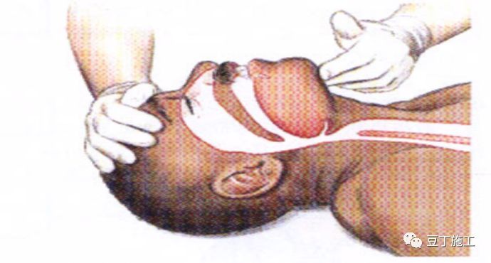 掌握这些建筑施工现场安全急救常识，关键时候有大用_11